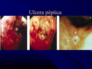 Ulcera péptica
 