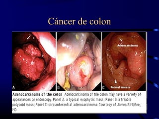 Cáncer de colon
 