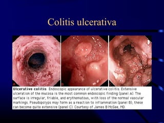 Colitis ulcerativa
 