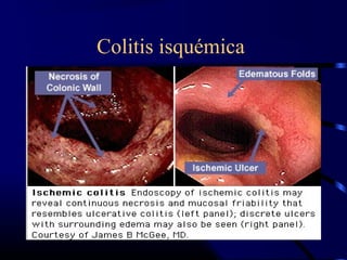 Colitis isquémica
 