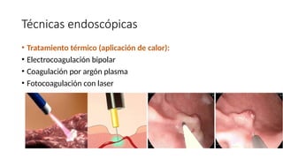 Técnicas endoscópicas
• Tratamiento térmico (aplicación de calor):
• Electrocoagulación bipolar
• Coagulación por argón plasma
• Fotocoagulación con laser
 
