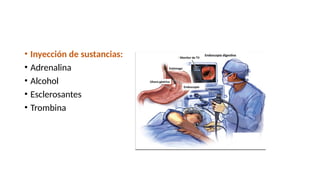 • Inyección de sustancias:
• Adrenalina
• Alcohol
• Esclerosantes
• Trombina
 