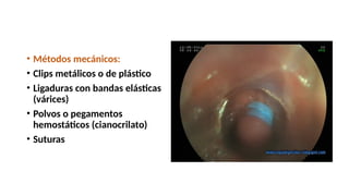 • Métodos mecánicos:
• Clips metálicos o de plástico
• Ligaduras con bandas elásticas
(várices)
• Polvos o pegamentos
hemostáticos (cianocrilato)
• Suturas
 