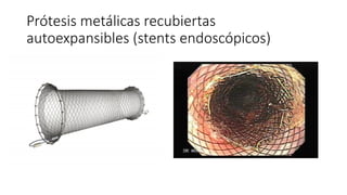 Prótesis metálicas recubiertas
autoexpansibles (stents endoscópicos)
 