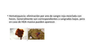 • Hematoquecia: eliminación por ano de sangre roja mezclada con
heces. Generalmente son correspondientes a sangrados bajos, pero
en caso de HDA masiva pueden aparecer.
 