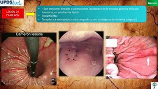 Hemorragia digestiva alta no variceal