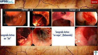 Hemorragia digestiva alta no variceal