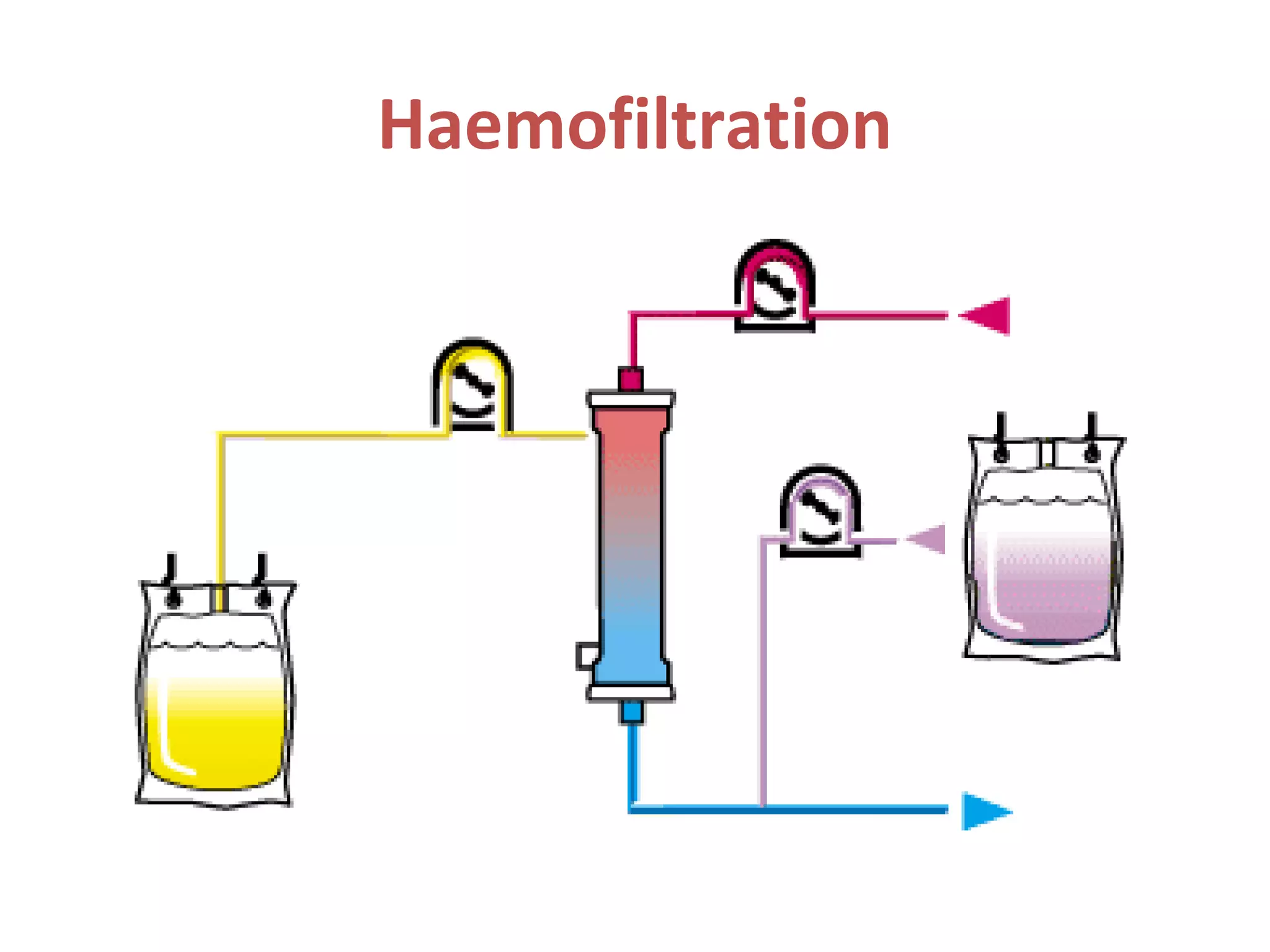 Haemofiltration
 