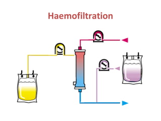 Haemofiltration
 