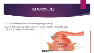 HEMORROIDES
Es la causa más frecuente de hemorragia digestiva baja.
Cuando la hemorragia por hemorroides es importante o recurrente, debe
practicarse tratamiento quirúrgico.
 