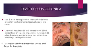 DIVERTÍCULOS COLÓNICA
 Sólo el 3-5% de los pacientes con divertículos cólica
presentan una hemorragia digestiva baja por esta
causa.
 La elevada frecuencia de esta entidad en los países
occidentales, en especial en pacientes mayores de 60
años, determina que sea la causa más frecuente de
hemorragia de origen intestinal.
 El sangrado se debe a la erosión de un vaso en el
fondo del divertículo.
 