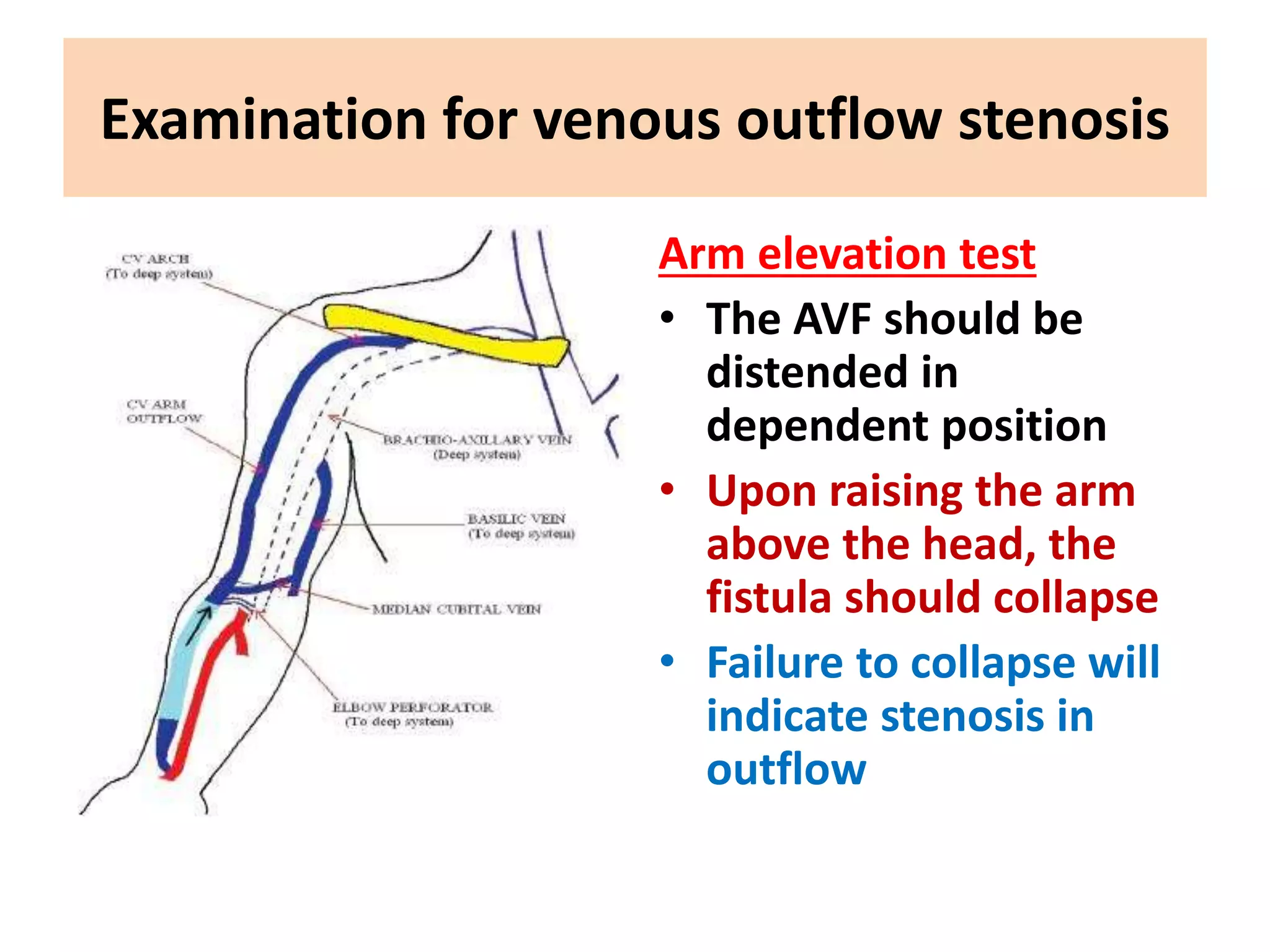 Examination for venous outflow stenosis
Arm elevation test
• The AVF should be
distended in
dependent position
• Upon raising the arm
above the head, the
fistula should collapse
• Failure to collapse will
indicate stenosis in
outflow
 
