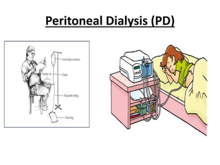 Peritoneal Dialysis (PD)
 