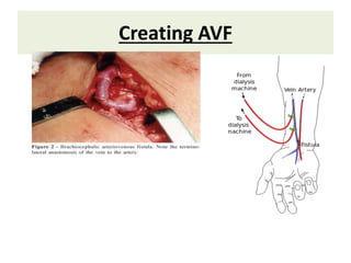 Creating AVF
 