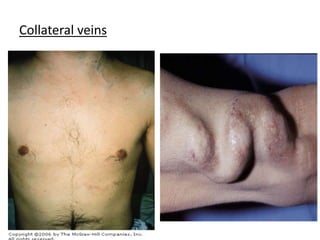 Collateral veins
 