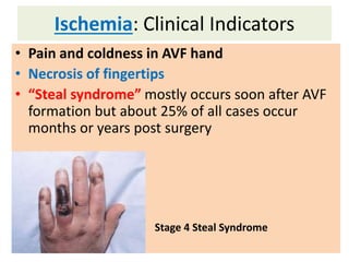 Ischemia: Clinical Indicators
• Pain and coldness in AVF hand
• Necrosis of fingertips
• “Steal syndrome” mostly occurs soon after AVF
formation but about 25% of all cases occur
months or years post surgery
Stage 4 Steal Syndrome
 