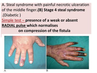 A. Steal syndrome with painful necrotic ulceration
of the middle finger.(B) Stage 4 steal syndrome
.(Diabetic )
Simple test – presence of a weak or absent
RADIAL pulse which normalises
on compression of the fistula
 