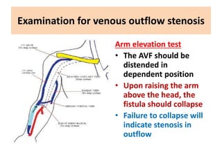 Examination for venous outflow stenosis
Arm elevation test
• The AVF should be
distended in
dependent position
• Upon raising the arm
above the head, the
fistula should collapse
• Failure to collapse will
indicate stenosis in
outflow
 