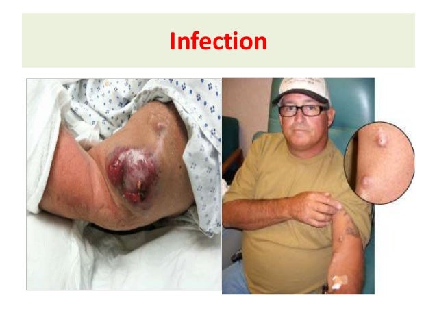 much when fluid how dialysis on Hemo DIALYSIS dialysis Access, much when fluid how dialysis on Hemo DIALYSIS dialysis Access,