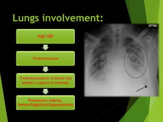 Lungs involvement:
High SBP
↑edarteriolarpr
↑edextravasation of blood into
alveoli + rupture of arteriole
Pulmonary edema,
hemorrhagicbrochopneumonia
 