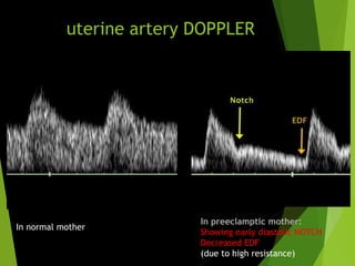uterine artery DOPPLER
In preeclamptic mother:
Showing early diastolic NOTCH
Decreased EDF
(due to high resistance)
In normal mother
 