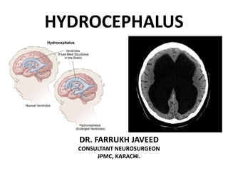 HYDROCEPHALUS
DR. FARRUKH JAVEED
CONSULTANT NEUROSURGEON
JPMC, KARACHI.
 