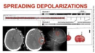 SPREADING DEPOLARIZATIONS
Vespa1999,Claassen2004,Vespa2005,Vespa2016,Harrings2012,Hartings2015
 