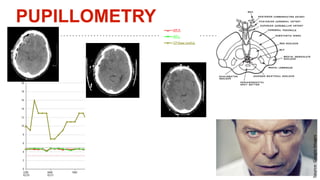 ICP
PUPILLOMETRY
Source:GoogleImages
 