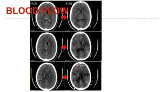 PTD0 PTD2 PTD3
CBF Probe
BLOOD FLOW
 