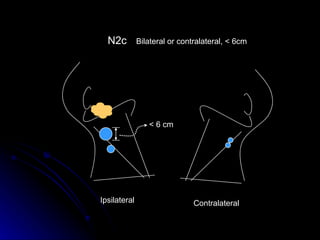 N2c Bilateral or contralateral, < 6cm Ipsilateral  < 6 cm Contralateral  