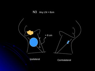 N3 Any LN > 6cm Ipsilateral  > 6 cm Contralateral  