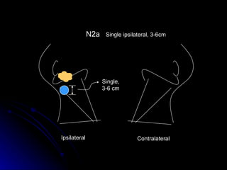 N2a Single ipsilateral, 3-6cm Contralateral  Ipsilateral  Single, 3-6 cm 