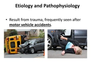 Etiology and Pathophysiology
• Result from trauma, frequently seen after
motor vehicle accidents.
 