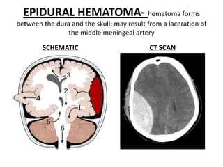 EPIDURAL HEMATOMA- hematoma forms
between the dura and the skull; may result from a laceration of
the middle meningeal artery
SCHEMATIC CT SCAN
 
