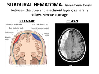 SUBDURAL HEMATOMA- hematoma forms
between the dura and arachnoid layers; generally
follows venous damage
SCHEMATIC CT SCAN
 