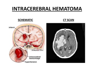 INTRACEREBRAL HEMATOMA
SCHEMATIC CT SCAN
 