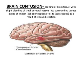 BRAIN CONTUSION- bruising of brain tissue, with
slight bleeding of small cerebral vessels into surrounding tissues
at site of impact (coup) or opposite to site (contracoup) as a
result of rebound reaction
 