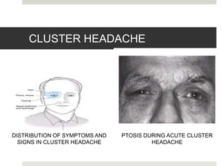 CLUSTER HEADACHE
DISTRIBUTION OF SYMPTOMS AND
SIGNS IN CLUSTER HEADACHE
PTOSIS DURING ACUTE CLUSTER
HEADACHE
 