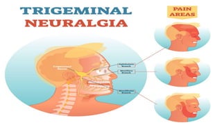22Trigeminal neuralgia
 