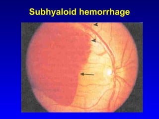 Subhyaloid hemorrhage 