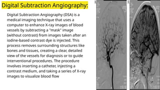Digital Subtraction Angiography:
Digital Subtraction Angiography (DSA) is a
medical imaging technique that uses a
computer to enhance X-ray images of blood
vessels by subtracting a "mask" image
(without contrast) from images taken after an
iodine-based contrast dye is injected. This
process removes surrounding structures like
bones and tissues, creating a clear, detailed
view of the vessels for diagnosis or to guide
interventional procedures. The procedure
involves inserting a catheter, injecting a
contrast medium, and taking a series of X-ray
images to visualize blood flow
 