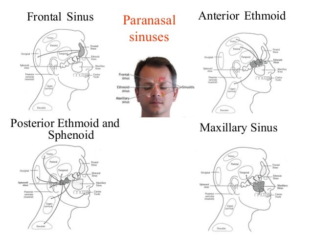 Headache During Pregnancy