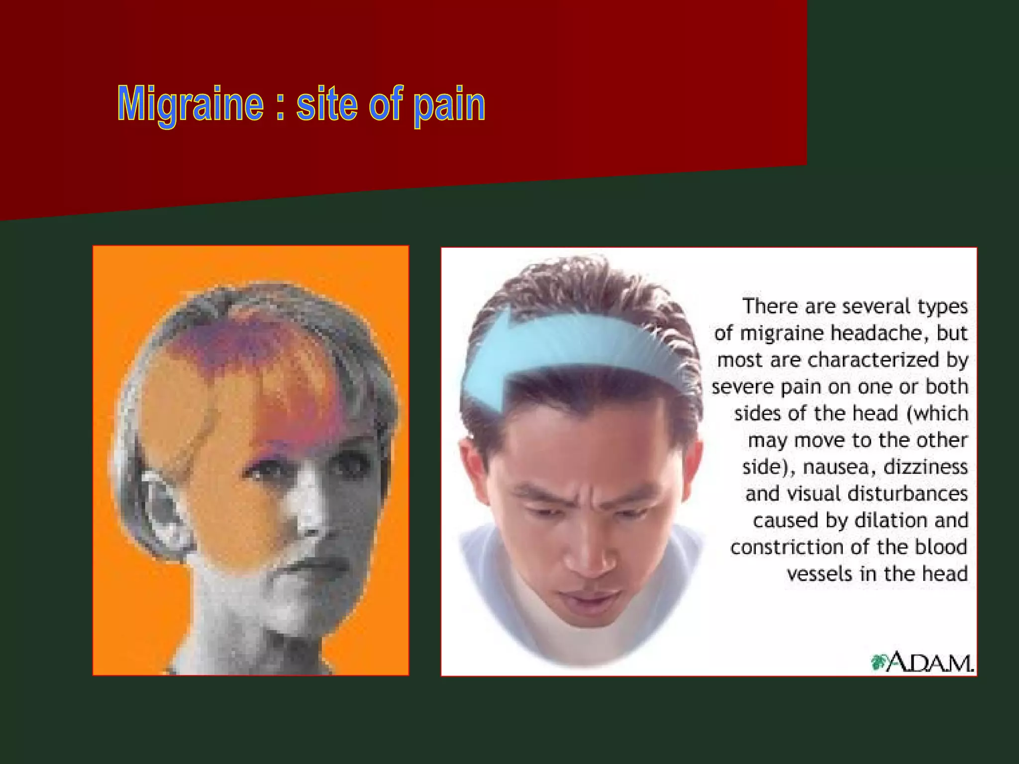 Migraine : site of pain 