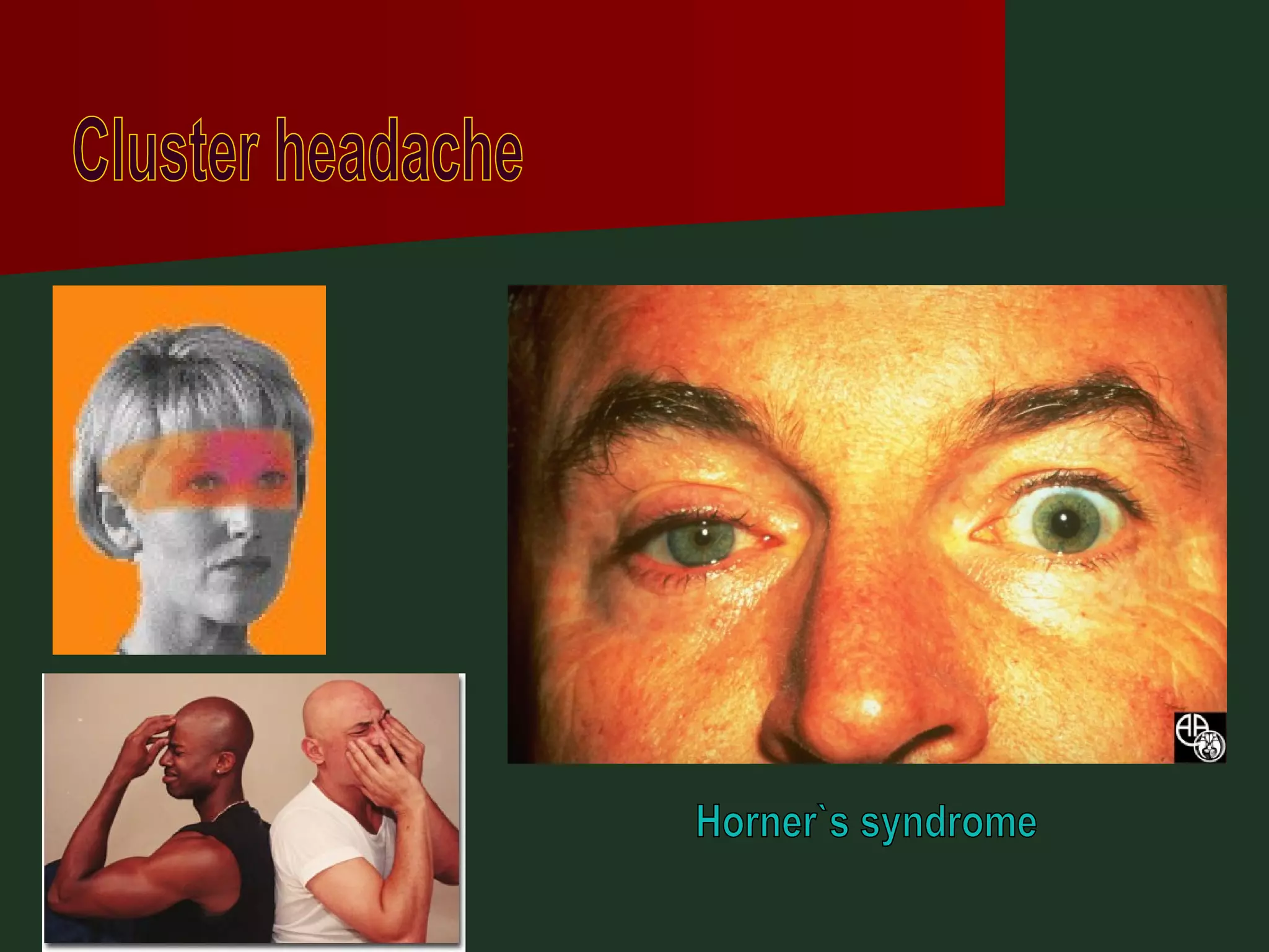 Cluster headache Horner`s syndrome 
