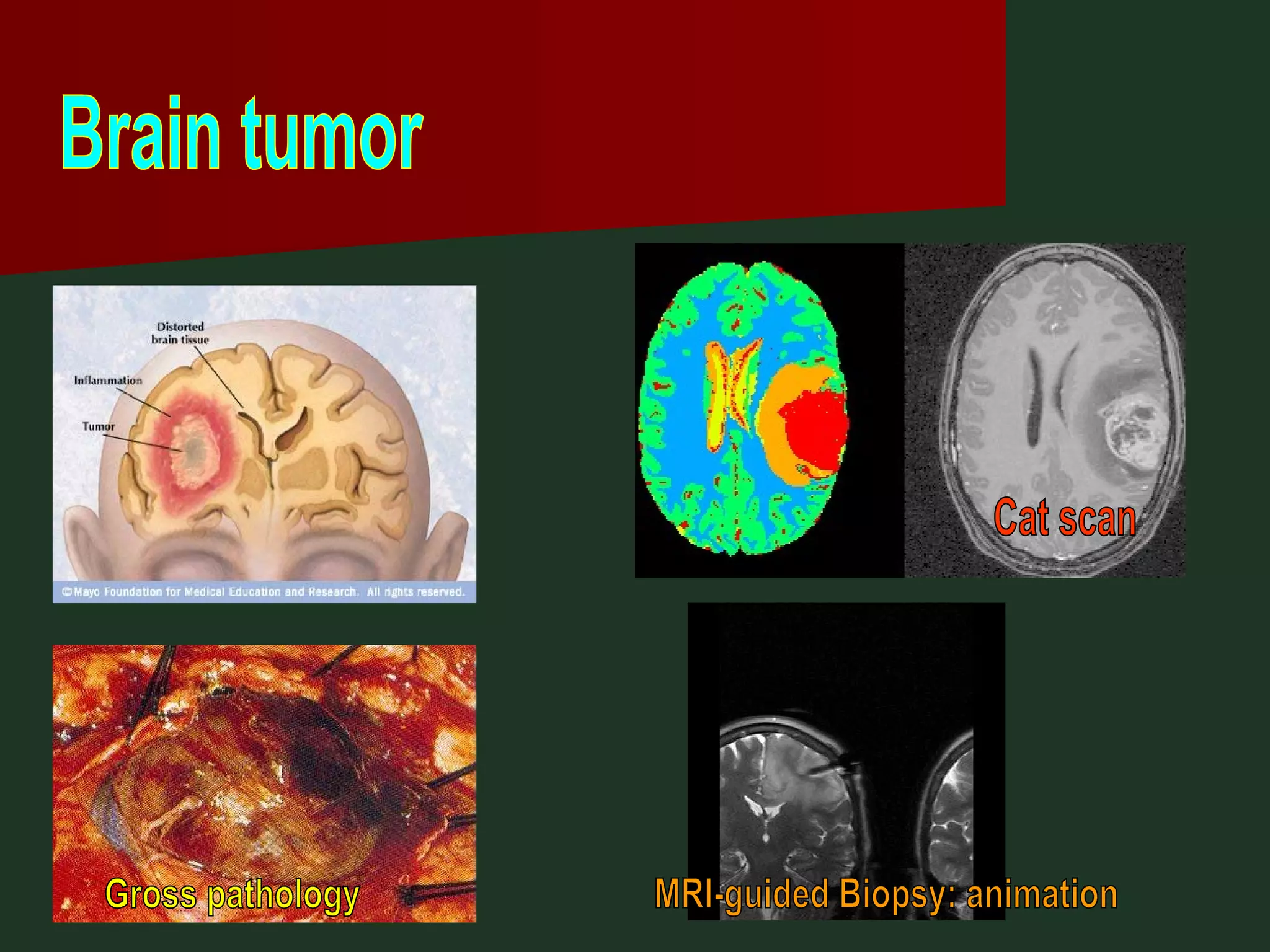 Brain tumor Cat scan MRI-guided Biopsy: animation Gross pathology 