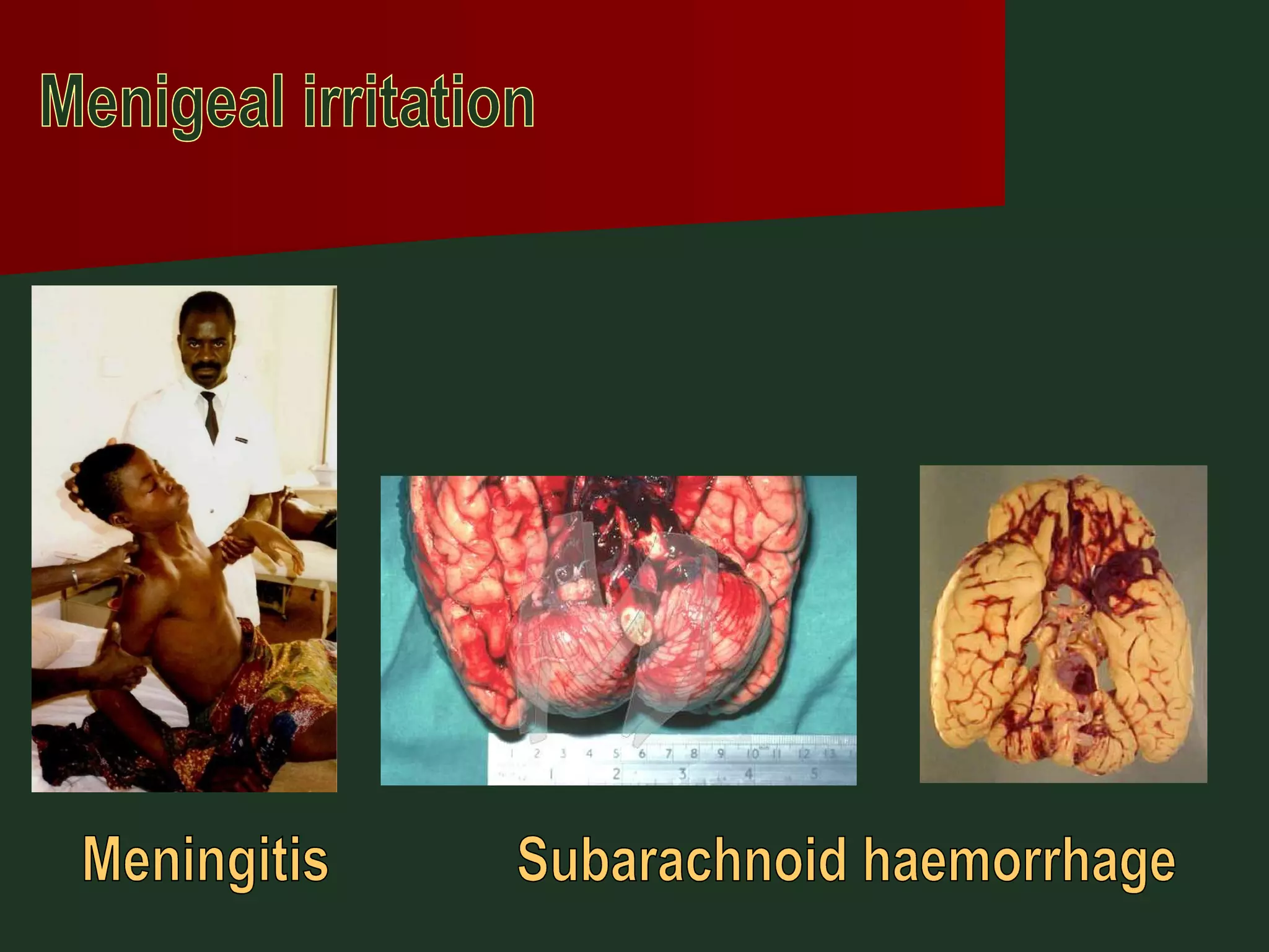 Subarachnoid haemorrhage Meningitis Menigeal irritation 