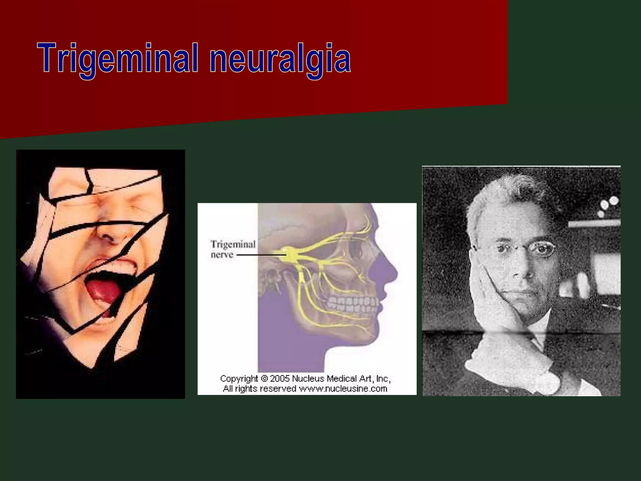 Trigeminal neuralgia 