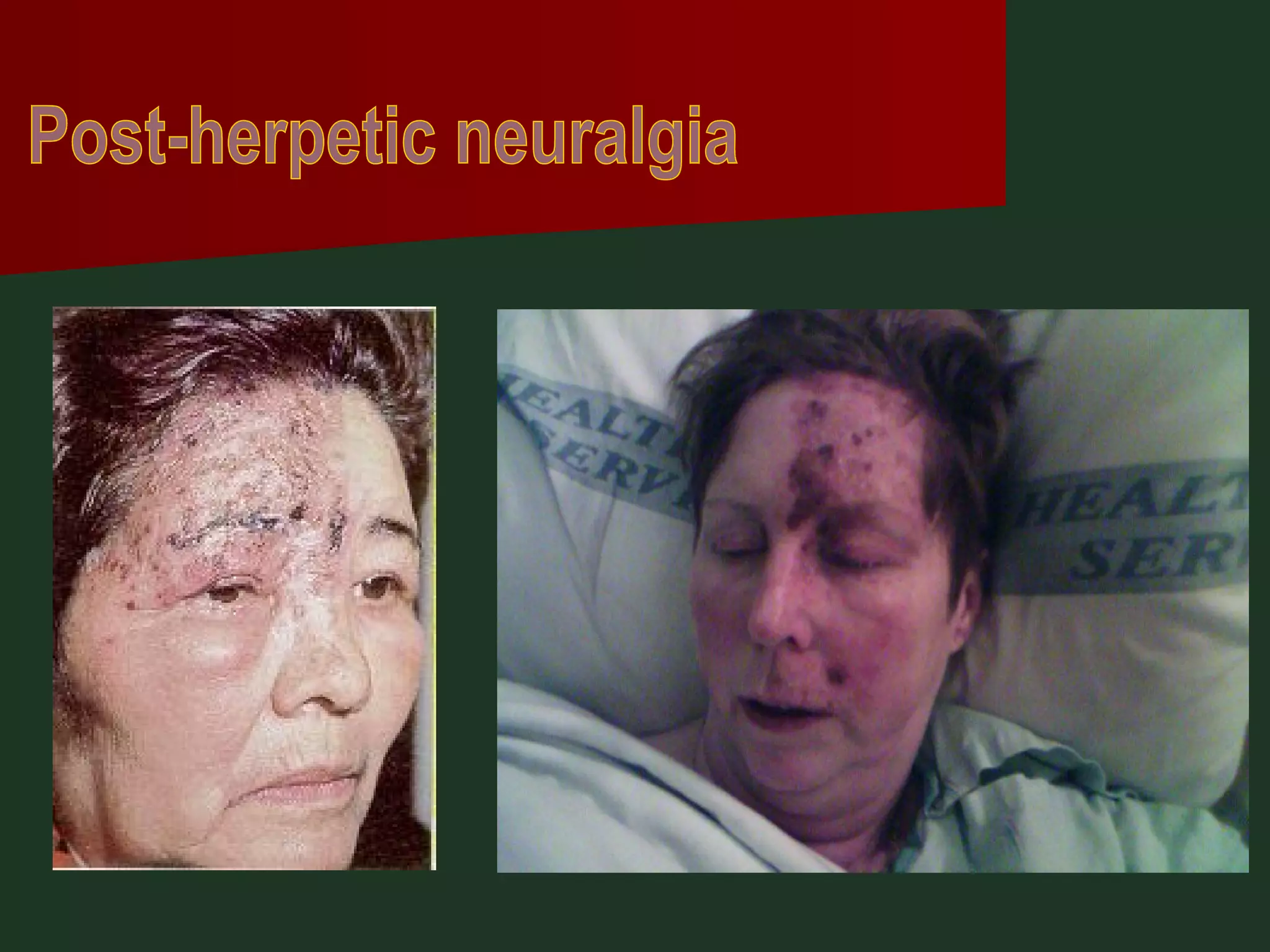 Post-herpetic neuralgia 