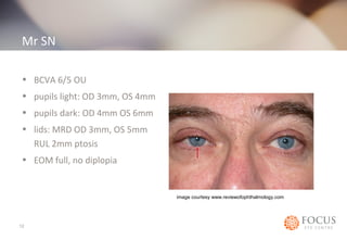 Mr SN 
• BCVA 6/5 OU 
• pupils light: OD 3mm, OS 4mm 
• pupils dark: OD 4mm OS 6mm 
• lids: MRD OD 3mm, OS 5mm 
RUL 2mm ptosis 
• EOM full, no diplopia 
12 
image courtesy www.reviewofophthalmology.com 
 