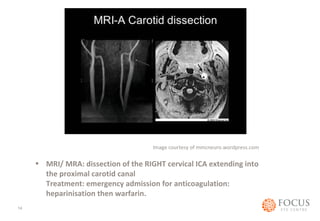Image courtesy of mmcneuro.wordpress.com 
• MRI/ MRA: dissection of the RIGHT cervical ICA extending into 
the proximal carotid canal 
Treatment: emergency admission for anticoagulation: 
heparinisation then warfarin. 
14 
